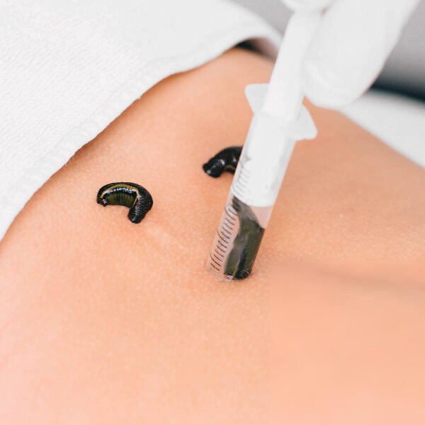 Medicinal leeches on the skin