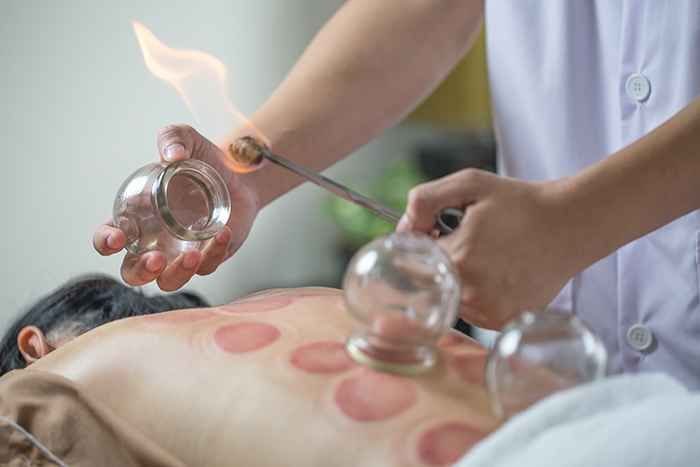 Practitioner lighting a cup with a flame over a marked back
